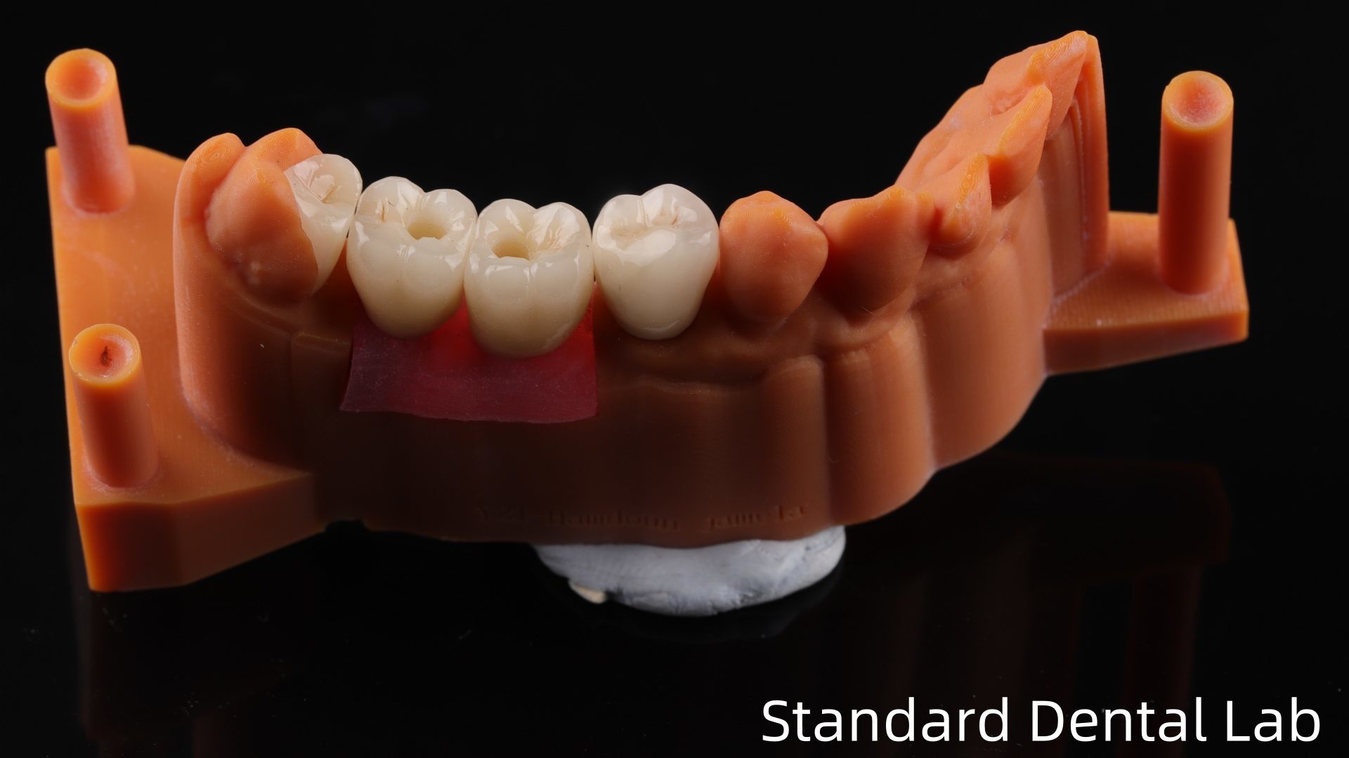 Screw Retained Dental Implant Crown with PFZ Porcelain Layered Zirconia 5-Year Gurantee and 3D Print Model