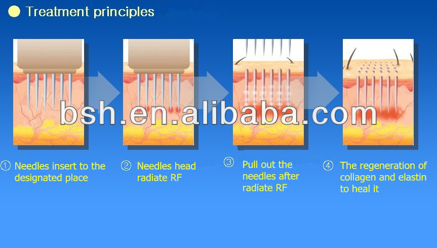 BF1302 Skin Rejuvenation Anti-wrinkle RF Facial Machine Home Use RF Skin Tightening Machine