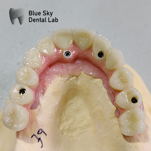 Implant Operation Cases / Implant Procedure Cases for Diverse Implant Choices and Sterilizations