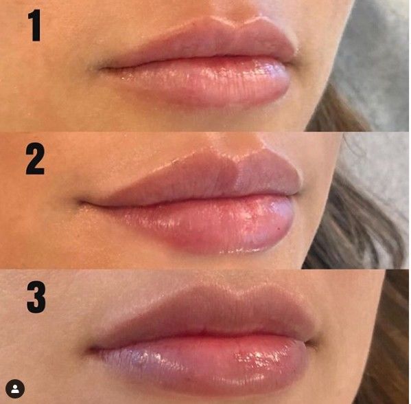 Juvederm