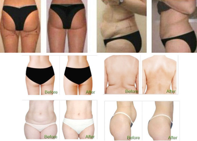 Cavitation Ultrasonic Liposuction RF Slimming Machine