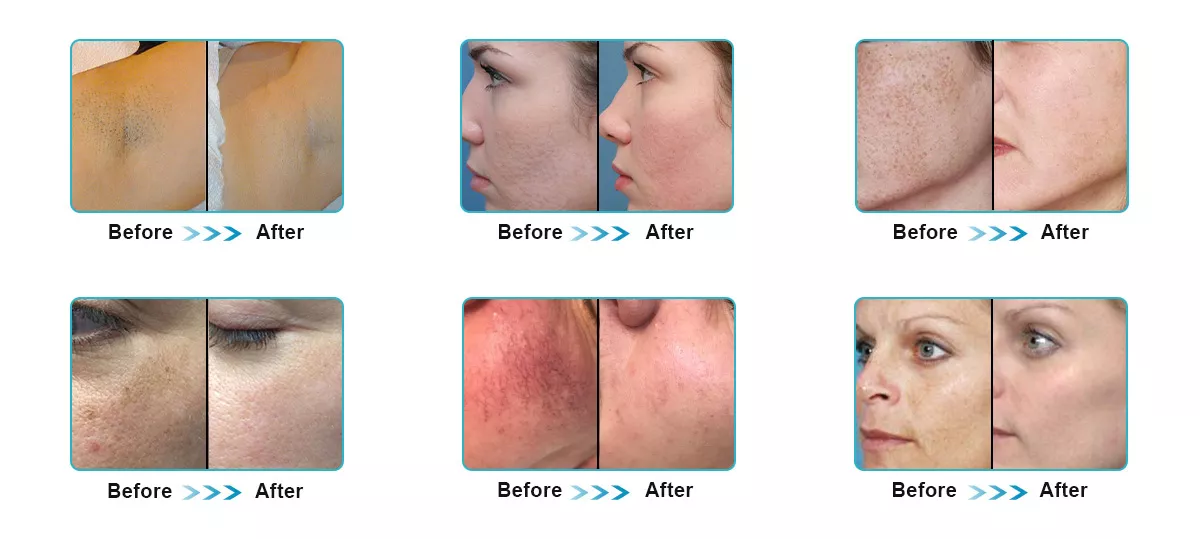 IPL E-Light SHR Hair Removal Skin Rejuvenation Acne Removal Pigment Removal Vascular Removal 3 In 1 Machine