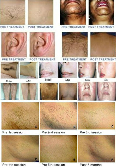 TOP Performance device !!! portable ipl hair removal machine for permanent hair removal