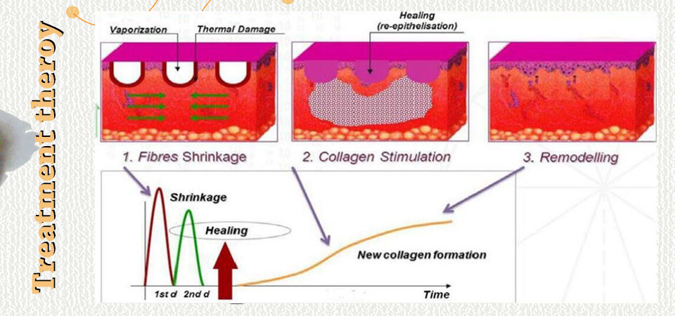 Vagina Tightening Lasertell Fractional Co2 Laser Machine 10600nm