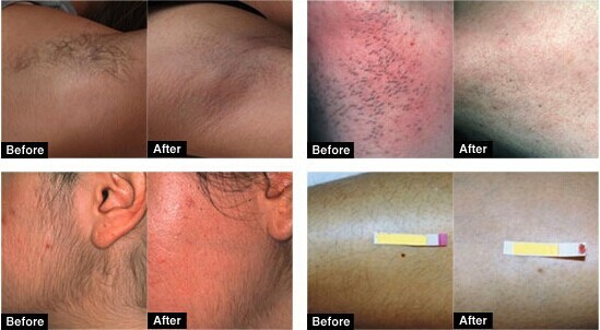 IPL hair removal machine skin rejuvenation machine intense pulsed light machine