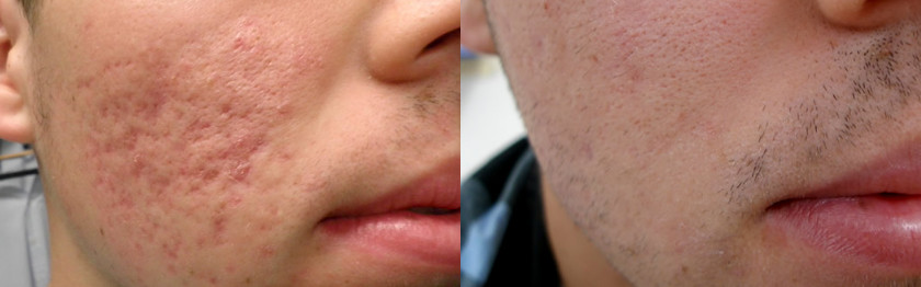 Sealed Off Fractional Co2 Laser For Acne Scars , Carbon Dioxide Laser Resurfacing Machine