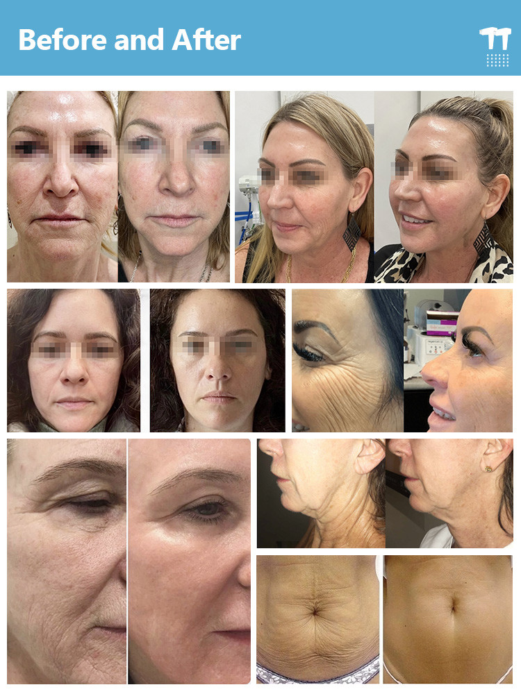 110V-240V Microneedling Machine With Adjustable Needle Depth For Skin Rejuvenation