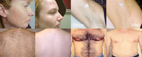 IPL hair removal machine skin rejuvenation machine intense pulsed light machine