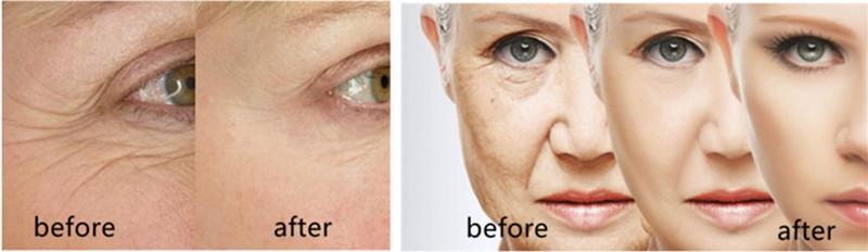 Skin Tightening AC110V 180W Microneedling Fractional RF