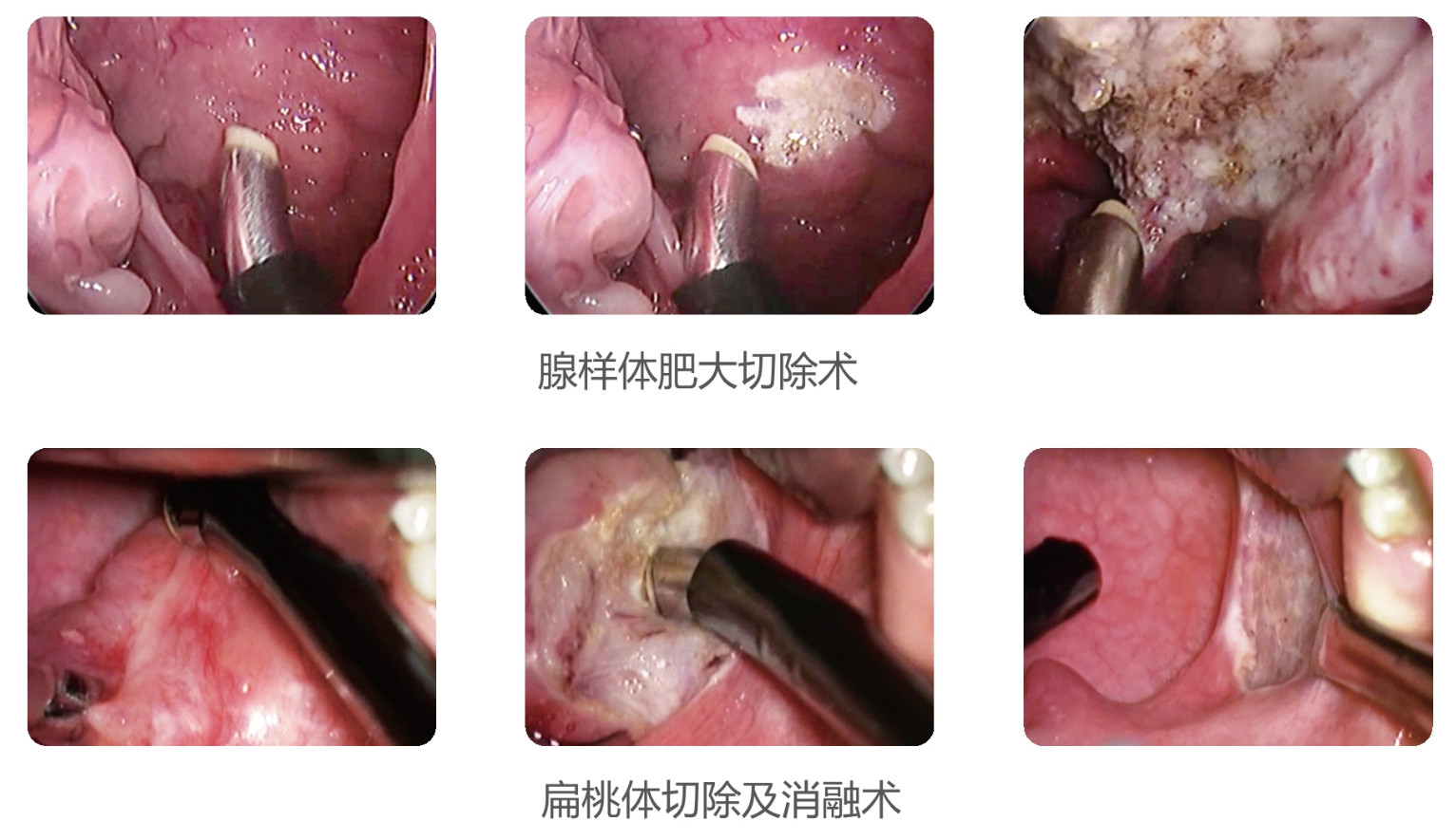Low Temperature RF Plasma System Cutting Perforation Ablation Cryosurgery Unit