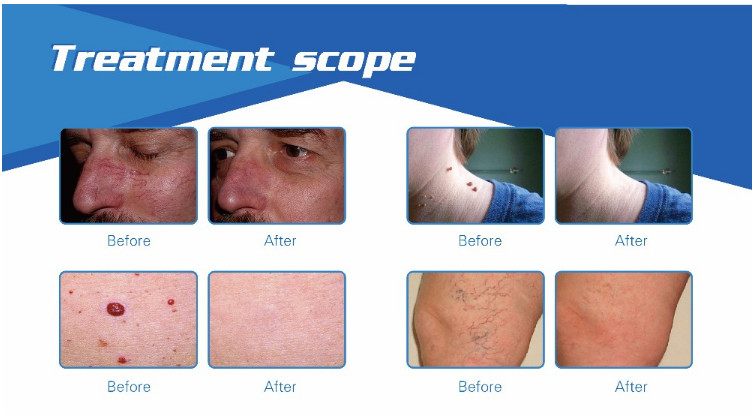 Top quality touching screen 635nm infrared ray varicose veins blood vessel removal laser diode 980nm