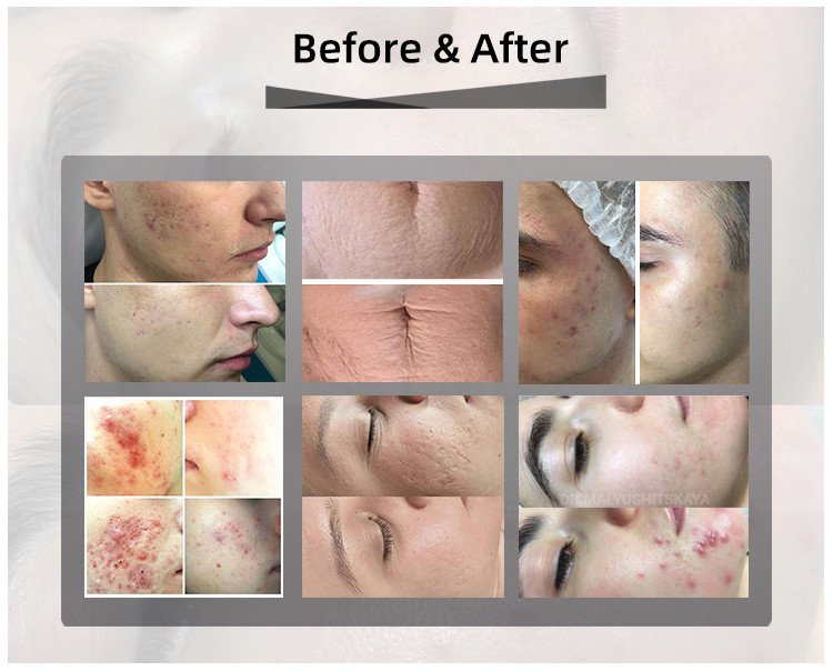 10600nm Co2 Fractional Laser Machine Vaginal Tightening Scar Removal