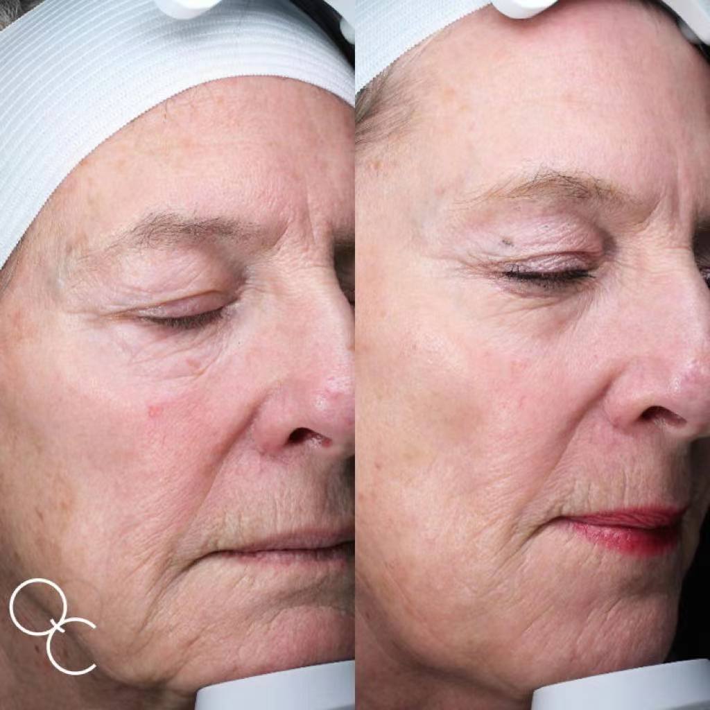 Tightening Skin Fractional CO2 Laser Beauty Machine For Acne Pigment Scar Removal