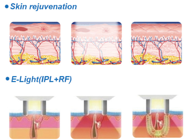 E-light ipl rf+nd yag laser multifunction machine intense pulsed light