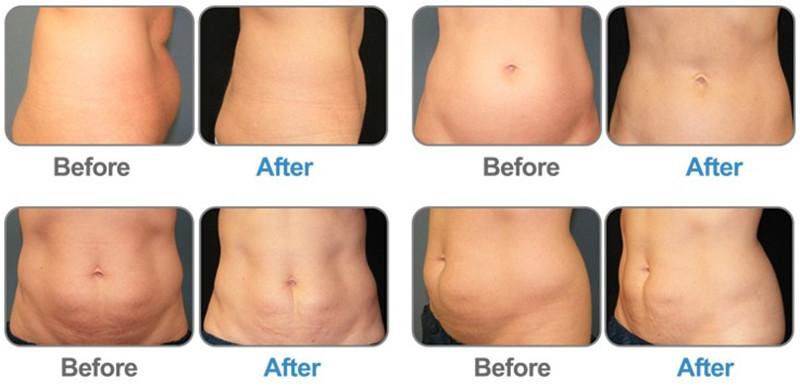 4 Handles 30Hz Cryolipolysis EMS Machine For Body Slimming