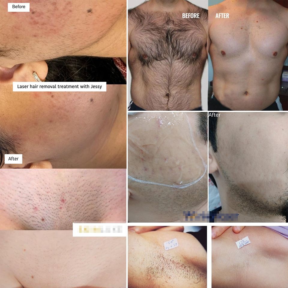 Permanent Hair Removal Diode Laser Machine 1200W For All Skin Types