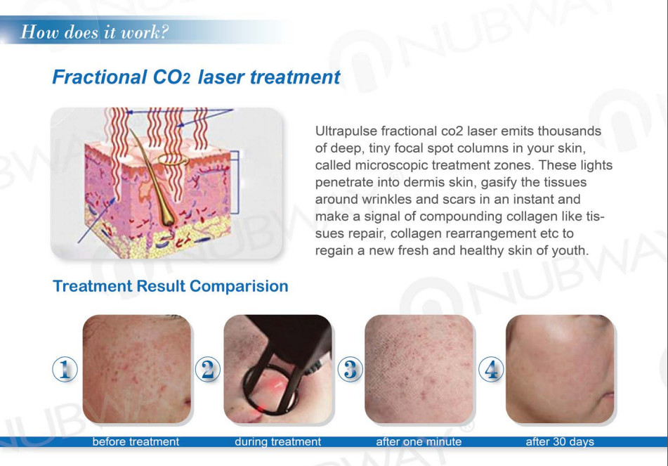 Fractional CO2 Laser Equipment Fractional CO2 Laser Acne Scar Removal