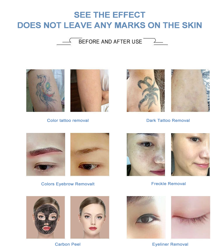 DPL laser beauty equipment nd yag Laser 1064 1320 532nm desktop laser tattoo pigment removal portable device