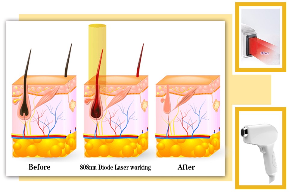 water+air+semiconductor cooling system hair removal diode laser machine