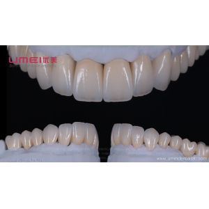 Zirconia crown