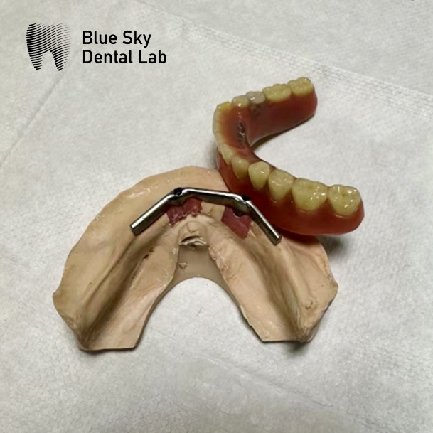 Full Mouth Dental Titanium Bar Accurate Removable Denture Restoration
