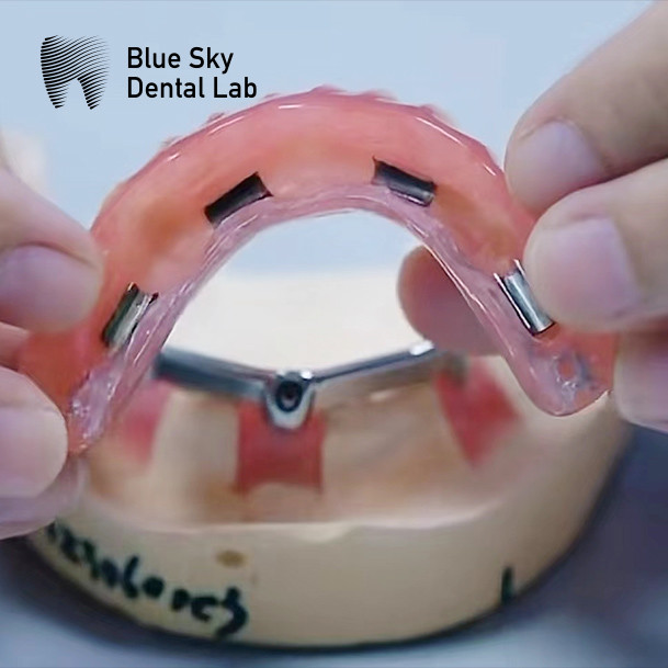 Full Mouth Dental Titanium Bar Accurate Removable Denture Restoration
