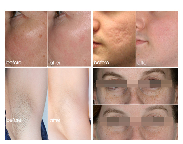 IPL DPL Skin Rejuvenation Machine , 4000W Laser Vascular Removal Machine