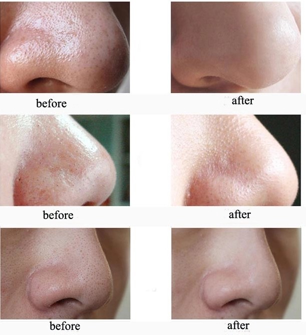 USB Charging ABS LCD Display Vacuum Blackhead Remover