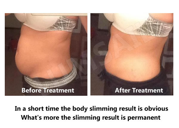 Cryolipolysis Weight Loss Equipment Slimming Machine