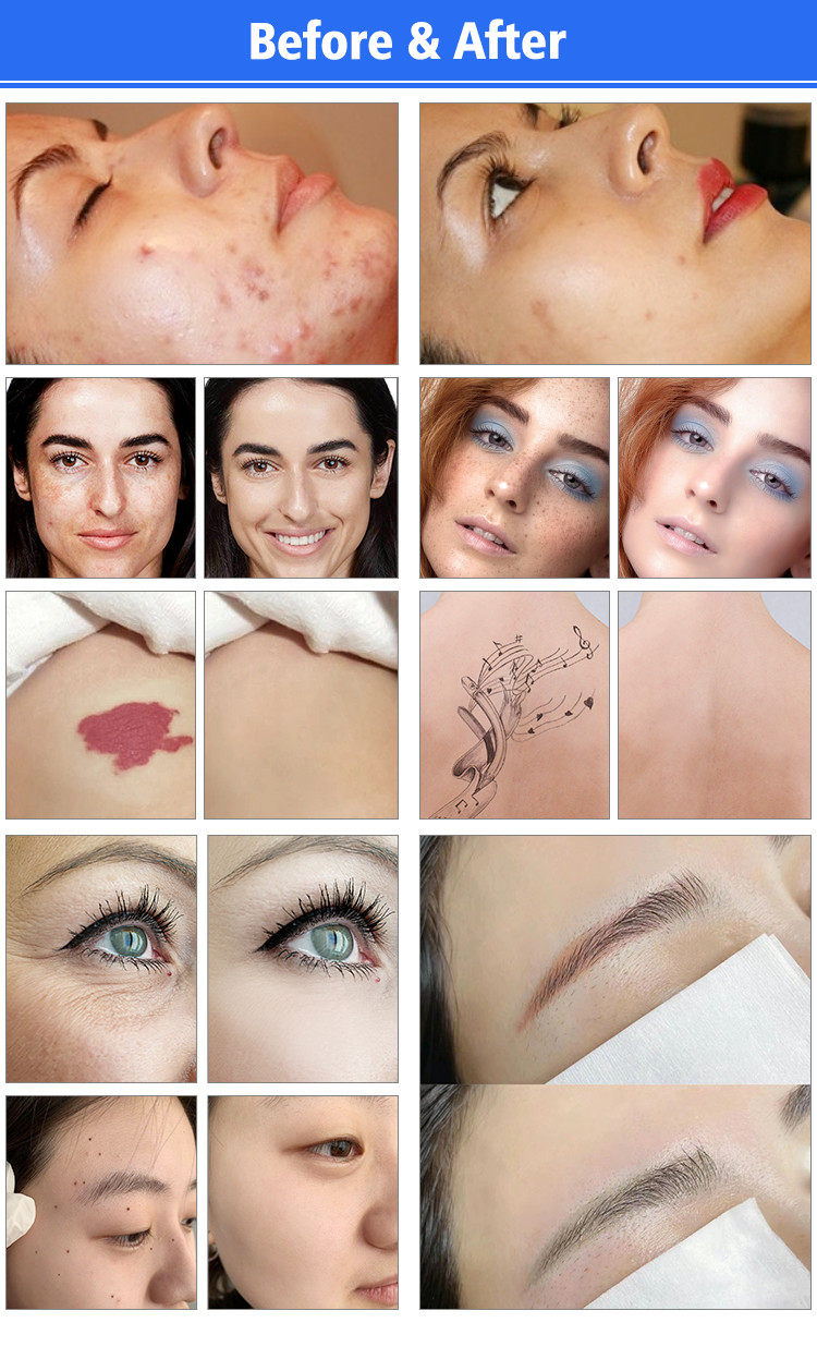 Q Switched Nd Yag Laser Tattoo Removal Machine Acne Scar Removal Laser Machine Pico Laser Machine