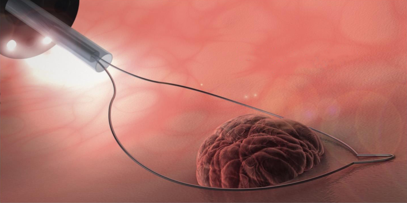 Disposable Cold Polyp Resection