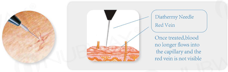 spider vein removal.png