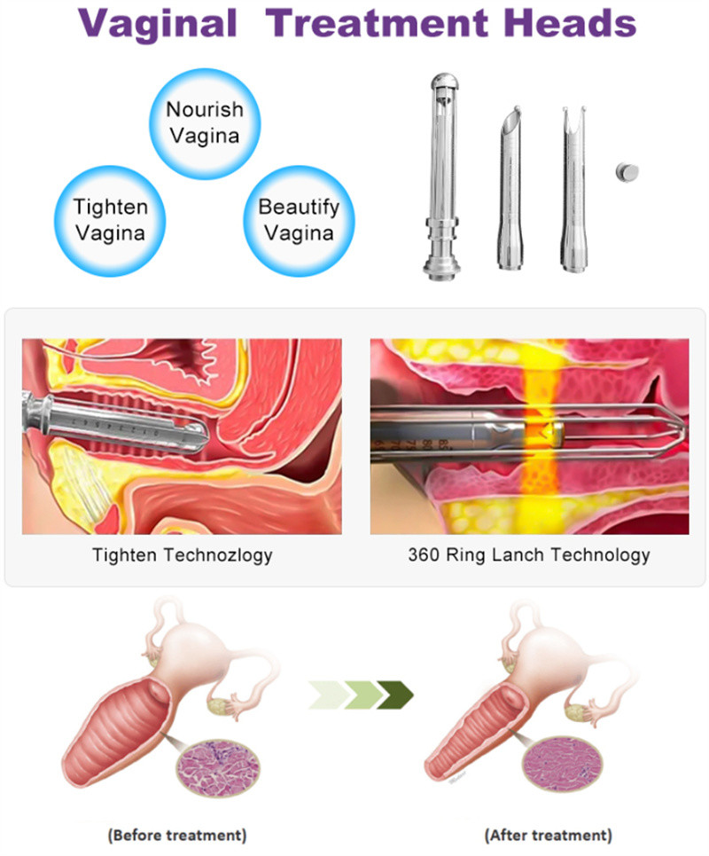 3 In 1 Fractional Co2 Laser Machine Skin Care Vaginal Tightening