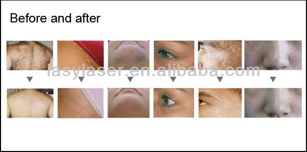 Home Use Laser Tattoo Removal Machine Multifunction Beauty For Beauty Salon
