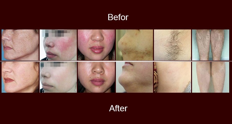 Skin Rejuvenation SHR IPL RF Beauty Equipment 10MHz RF Frequency With 3 Hand Pieces