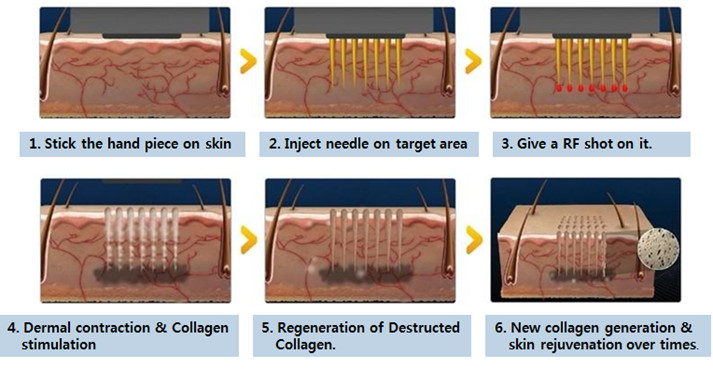 cpt skin rejuvenation machine fractional microneedle radiofrequency