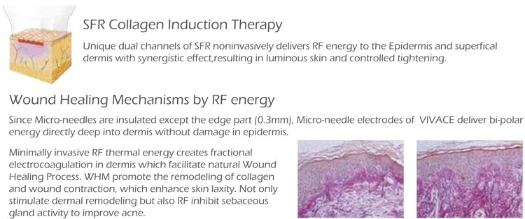 CE approved Nubway high quality 2018 fractional rf microneedle face treatment fractional rf microneedle machine for sale