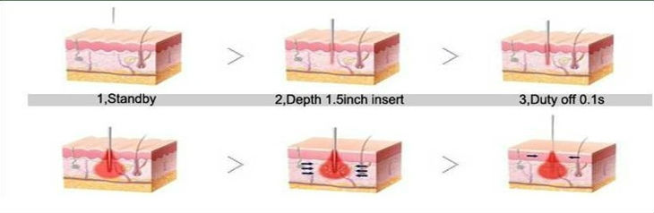Fractional RF Microneedle Machine.jpg