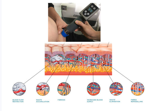 COOL WAVE Beauty Equipment Fat Removal Fat Freeze Cryolipolysis Shockwave Therapy Machine With CE