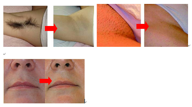 10 Bars 808nm professional hair removal laser machine big screen
