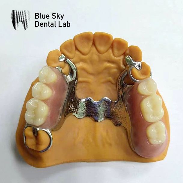 Removable Denture Rpd Framework Design Metal Partial Denture Framework Design