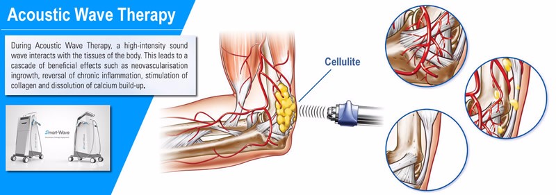 SmartWave Shock Wave Therapy Equipment For Pain Relief