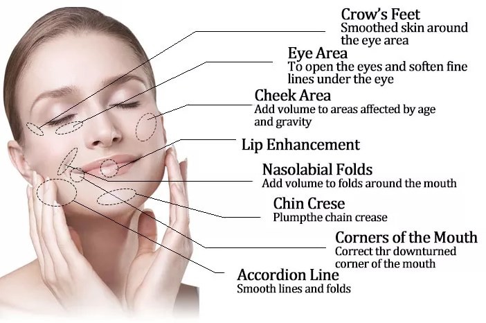 Fosyderm Injectable Hyaluornic Acid Dermal Filler with lidociane 2ml Lip Nose Face Fillers