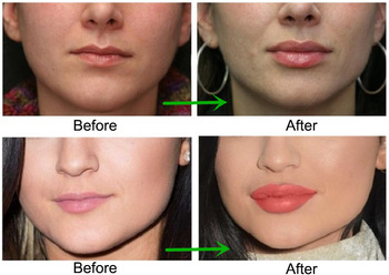 Fosyderm 2ml Deep Hyaluronic Acid Filler Injections For Shaping