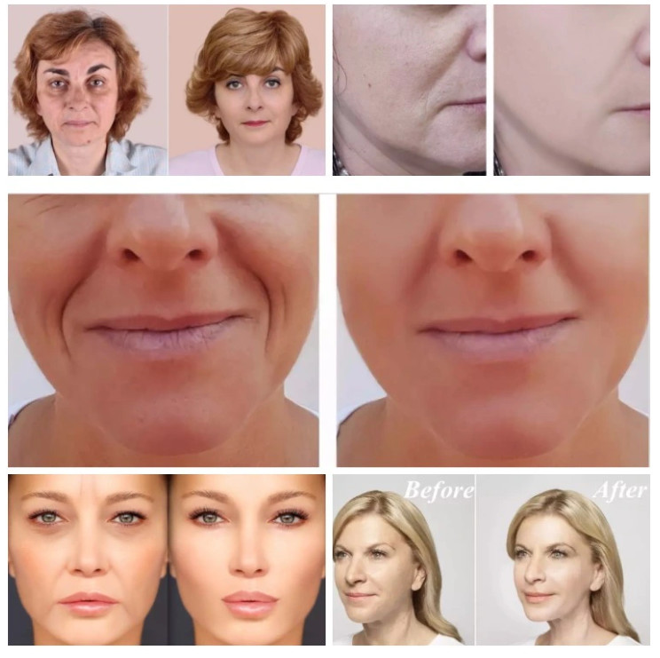 1.1cc Anti Aging Injectable Revolax Dermal Filler Natural Deep Hyaluronic Acid Filler