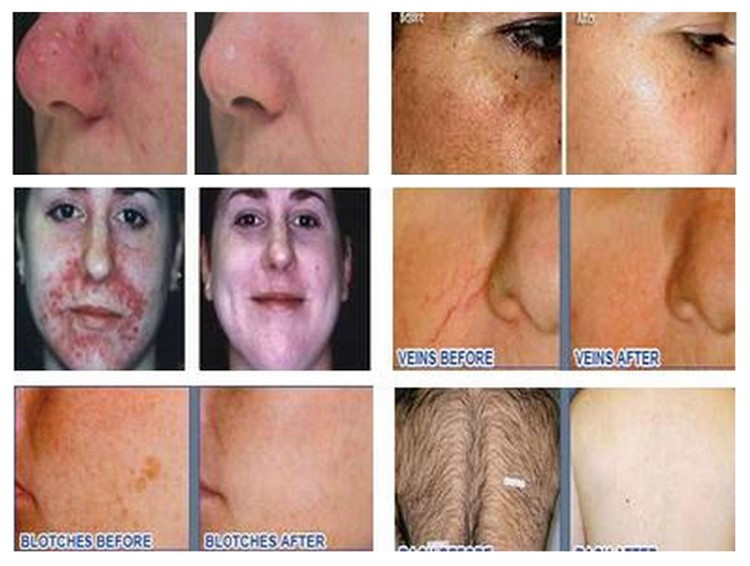 3 in1 laser elight ipl rf cavitation machine for hair removal wrinkle removal