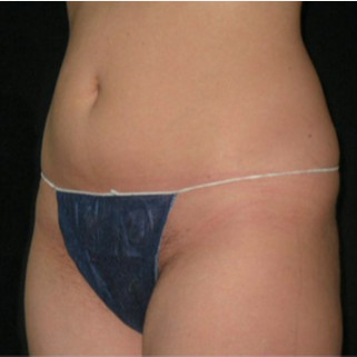 UltraShape-after-1549481-2138405.jpg
