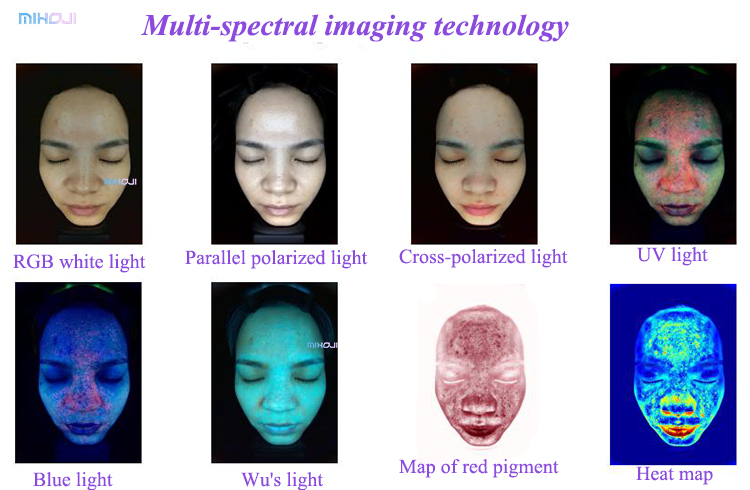 Effective Acne Treatment with Q1 Q2 Skin Analysis Machine and Pigmentation Analysis