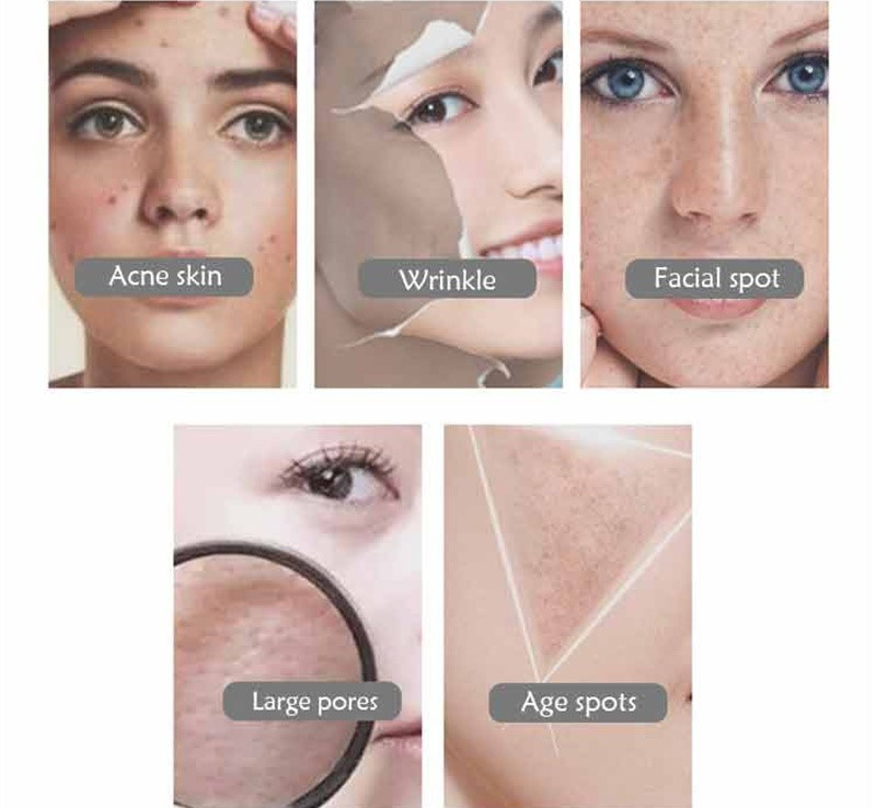 Handheld Facial Beauty Ozone Antibacterial Plasma Pen For Skin Care Facial Lifting