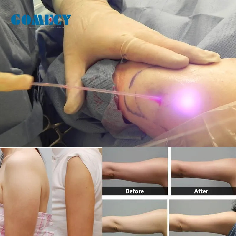 Laser Therapy Device Class Iv Laser Physical Therapy 810 980 1064nm Laser Therapeutic Apparatus